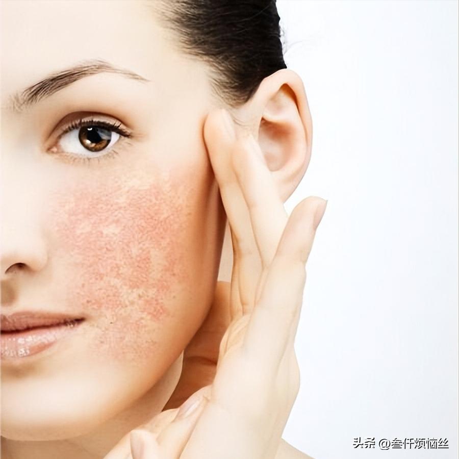 头发过敏用什么染发剂,染发剂过敏的一个现象