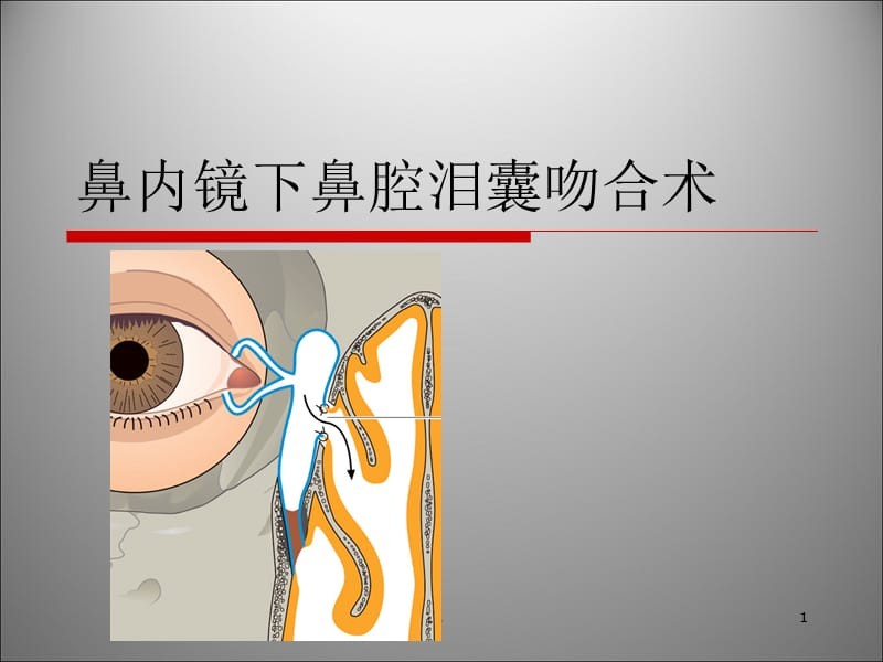 泪囊吻合手术和置管有啥区别,泪囊切除术是几类切口