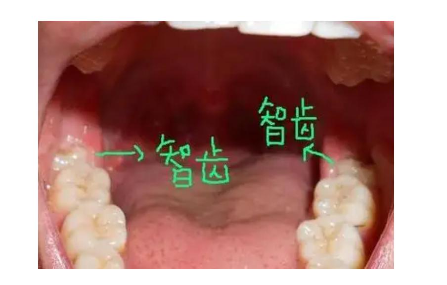 口腔经验贴,为什么口腔诊所拔智齿那么便宜