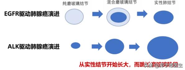 smarca-4缺陷型肺癌早期能手术吗,早期肺癌手术前一定要做petct吗