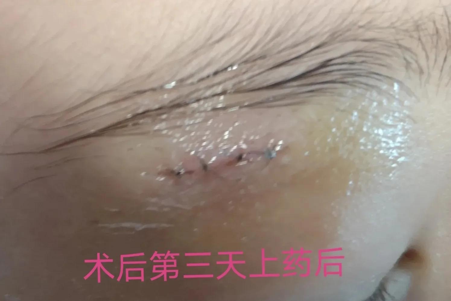 皮脂腺囊肿挤出囊袋,皮脂腺囊肿切除手术