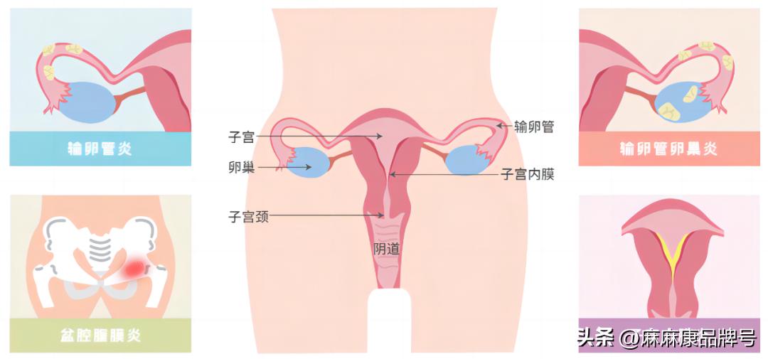 妇科宫颈炎怎么引起的,妇科宫颈炎是什么原因