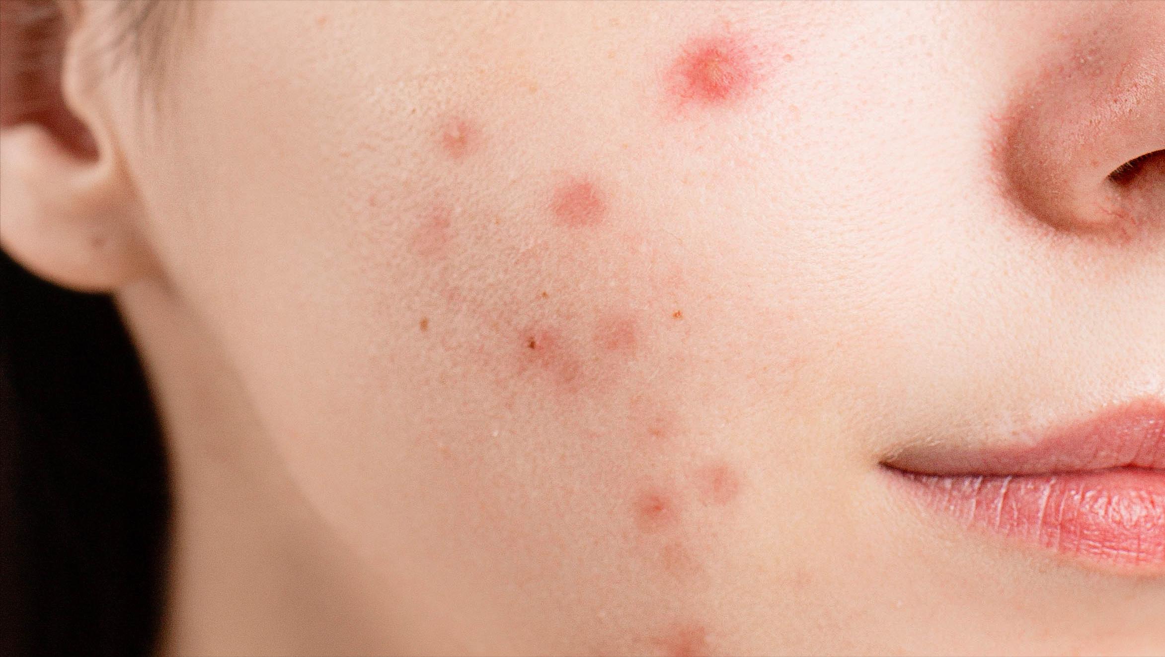 男生护肤心得,壬二酸痘肌凝胶祛痘