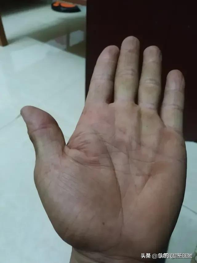 掌纹诊病学视频,掌纹诊疗