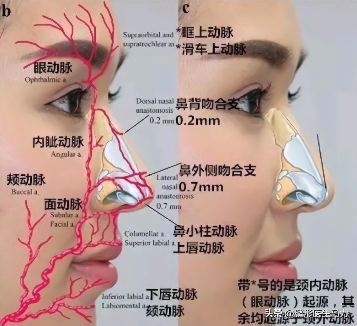 鼻基底玻尿酸栓塞后续治疗方法,鼻基底打玻尿酸栓塞后打溶解酶
