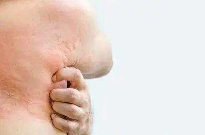 身上腰部起红疙瘩越挠越痒还扩散,后背长红疙瘩是怎么回事越挠越痒