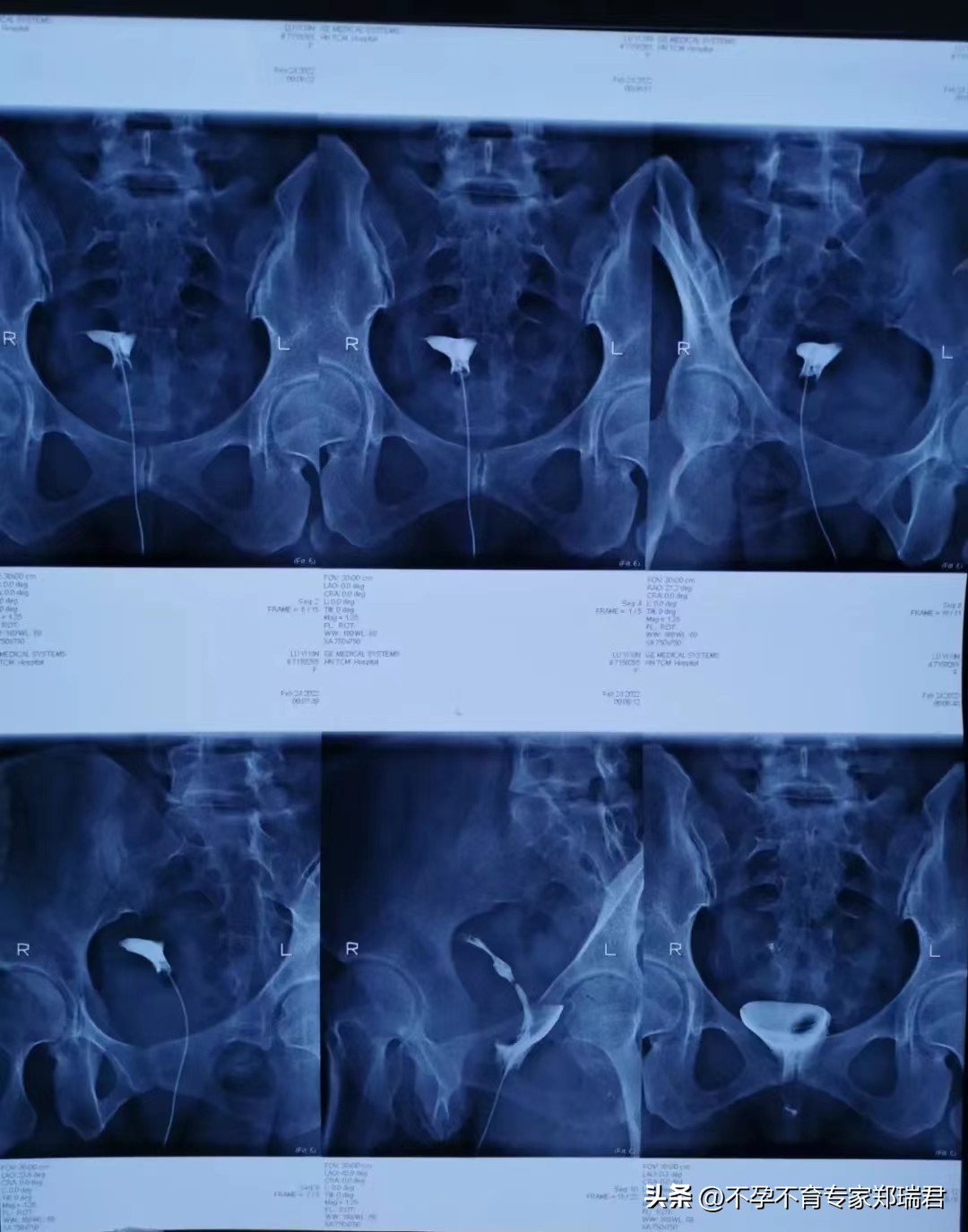一侧输卵管不通能怀孕吗,输卵管一边通一边不通能怀孕吗