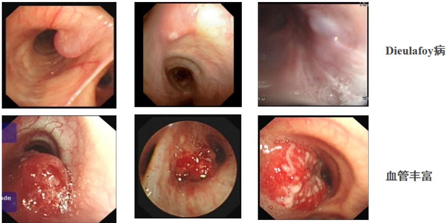 咯血一定要做支气管镜吗,支气管镜的注意事项