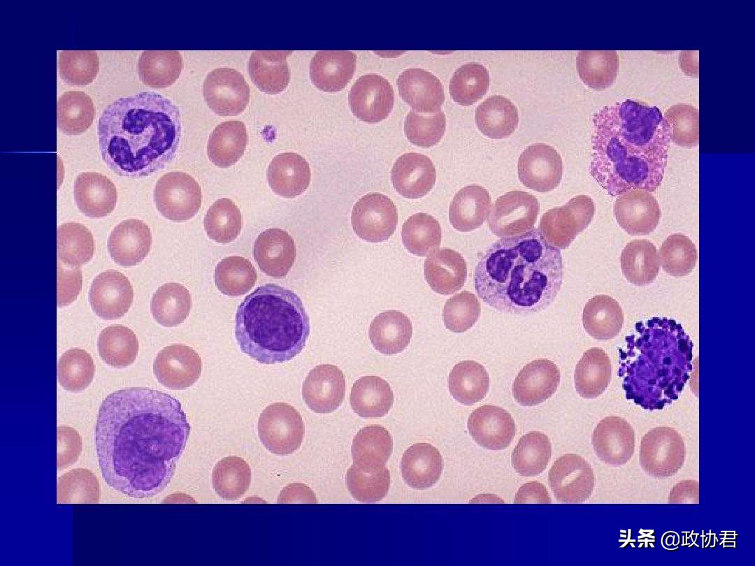 慢粒白血病靶向药伊马替尼,白血病新药的研发