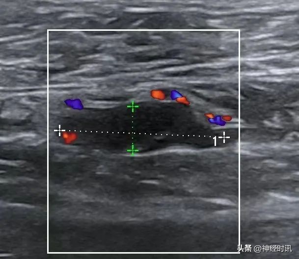 血栓用肝素抗凝管多久凝血,肌间静脉血栓需要绝对卧床吗