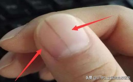 手指甲发白没有月牙有明显竖纹,手指甲有月牙和条纹是什么原因