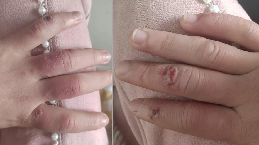 倪海厦当归四逆汤治冻疮,冻疮用四逆汤还是当归四逆汤