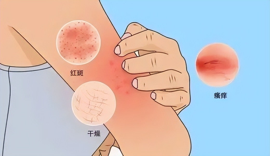 红霉素祛老年斑最有效的偏方,祛老年斑小妙招红霉素软膏