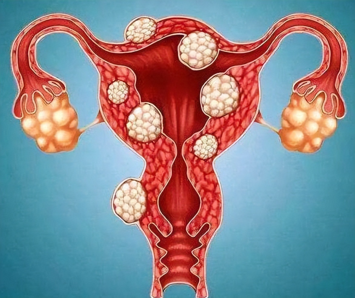 怎么避免长子宫肌瘤,什么情况才会导致长子宫肌瘤