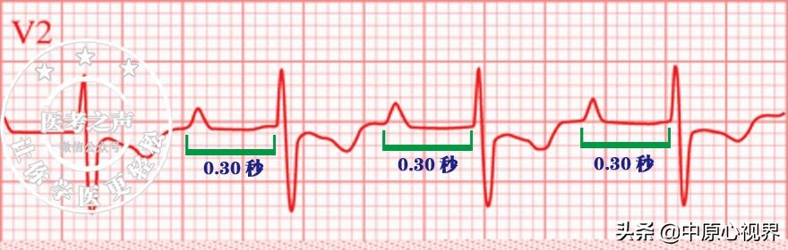 护考几种常见的心电图,常见的心电图图形分析