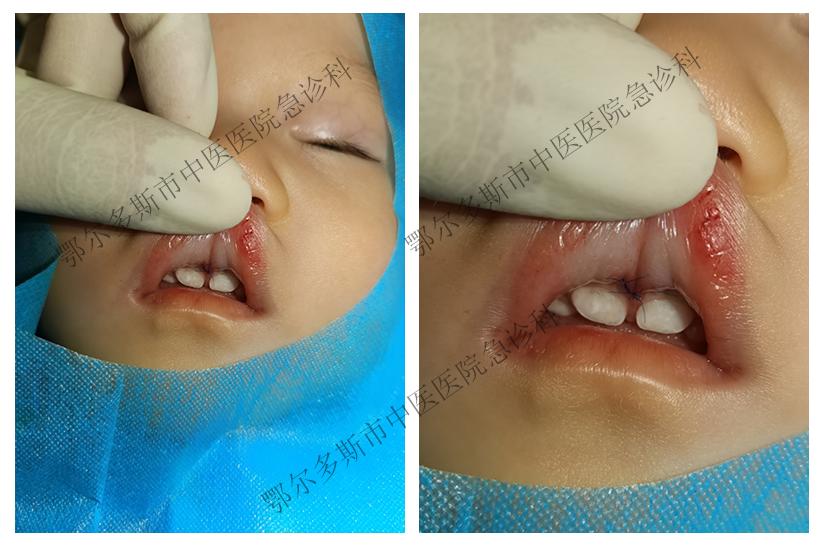 鄂尔多斯市中医医院急诊科,急诊科美容缝合后护理