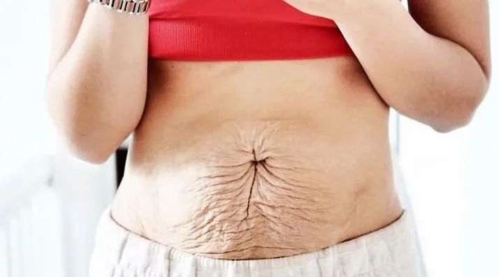 生完孩子后减肥肚子松弛,肚子妊娠纹松弛锻炼可以消除吗