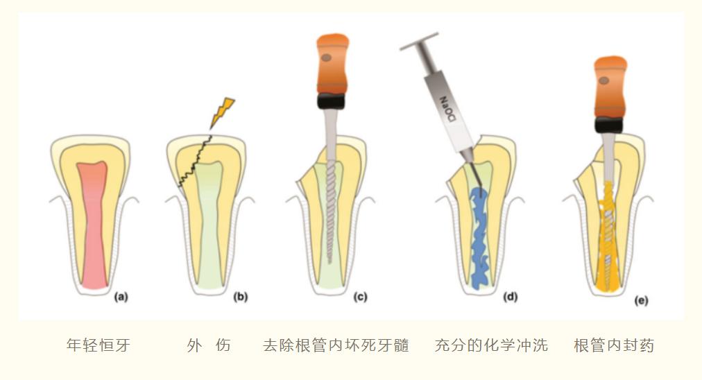 18岁大门牙断牙修复最佳方法,大门牙缺了牙髓没了
