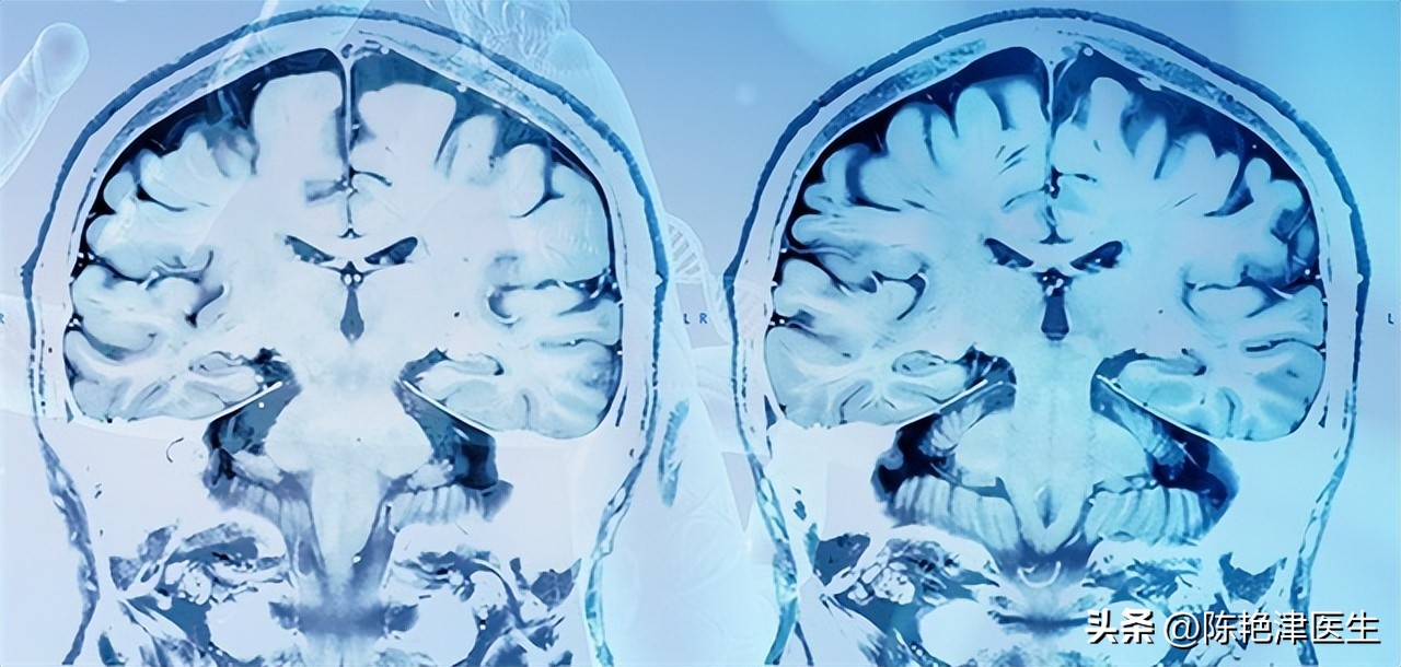 58岁男子吃他汀1年后复查,36岁有颈动脉斑块吃他汀行吗