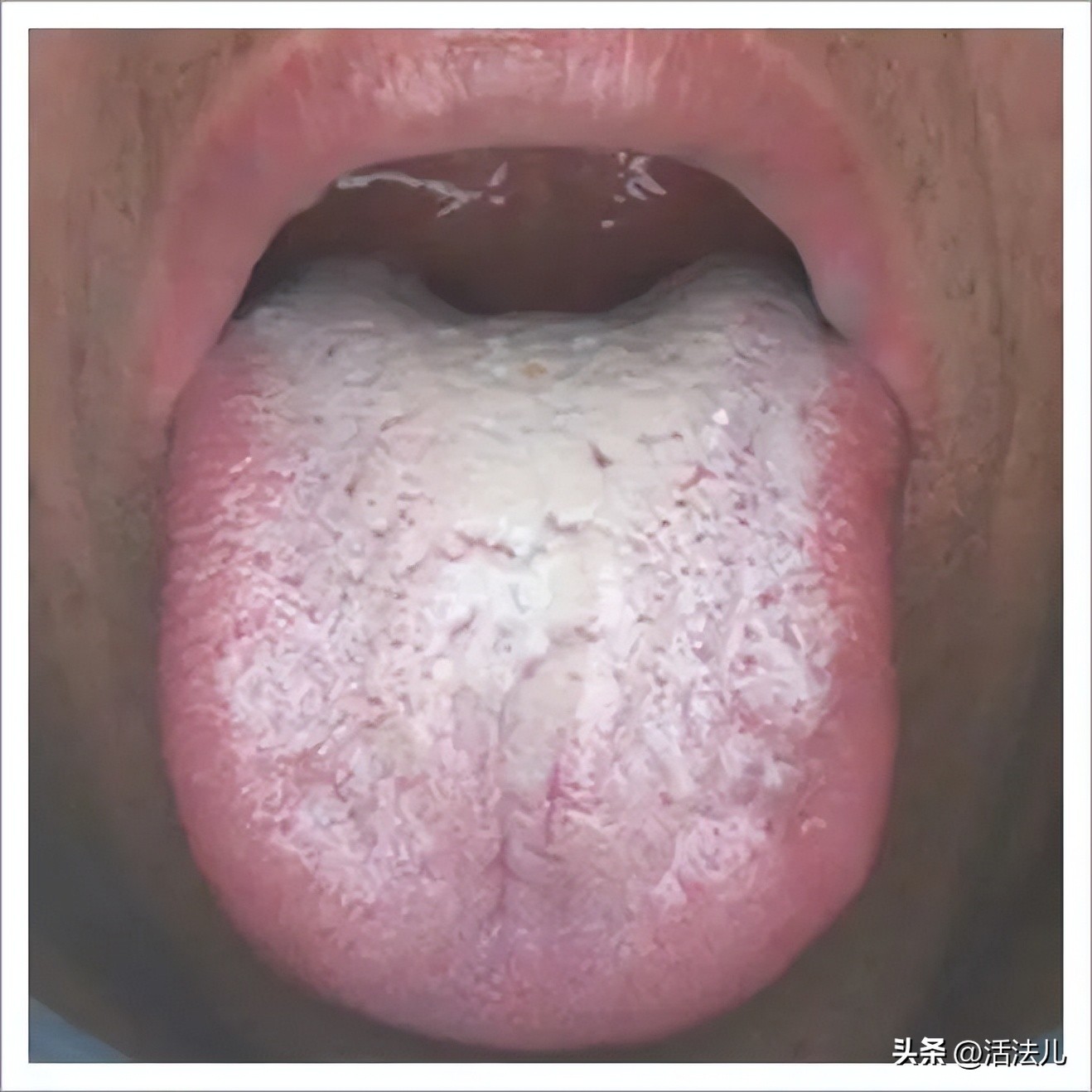 新冠专挑软柿子捏？60个阳性患者都有的3个共性，尤其是这3类人