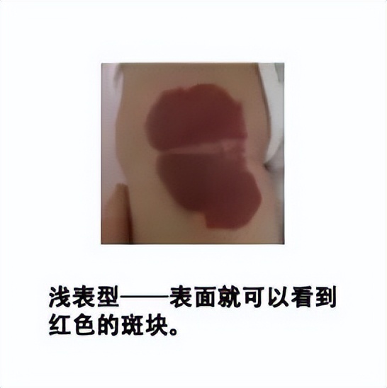 小孩胎记长肉瘤,小孩身上一块黑色胎记越长越大