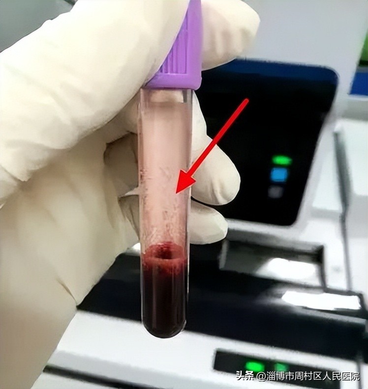 血液标本溶血对检测的影响,血液标本出现溶血是什么意思