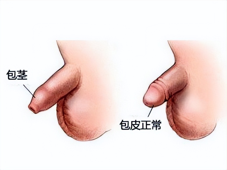 成年人包皮过长可以做手术吗,包茎包皮过长坚决不手术该咋办