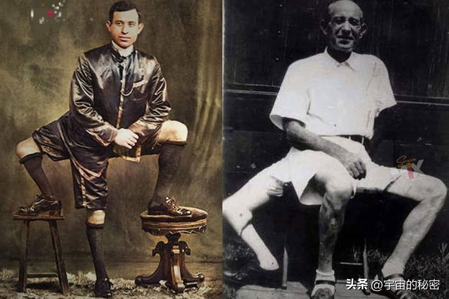 这个美国人有三条腿4只脚2个把！但他还结了婚有了4个孩子