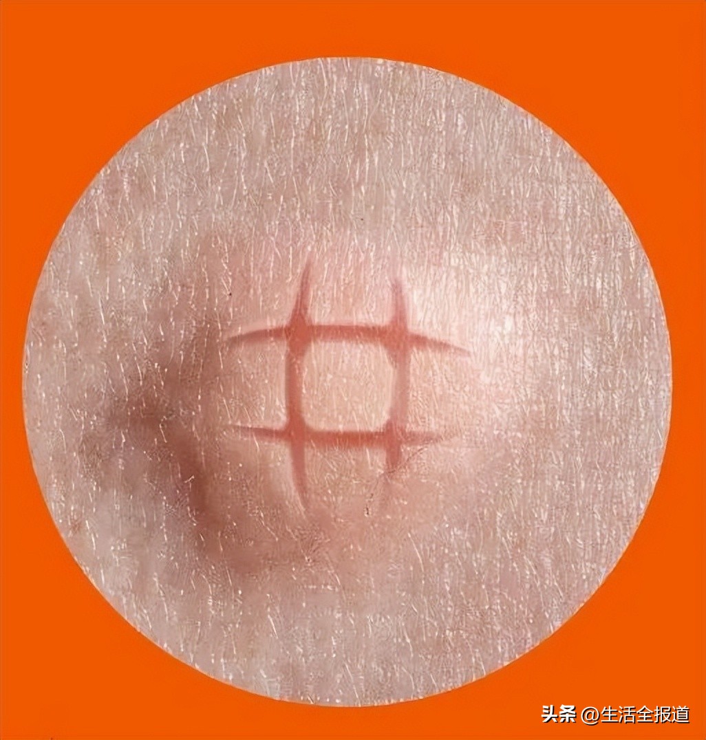 蚊子包止痒妙招,怎么给蚊子包止痒