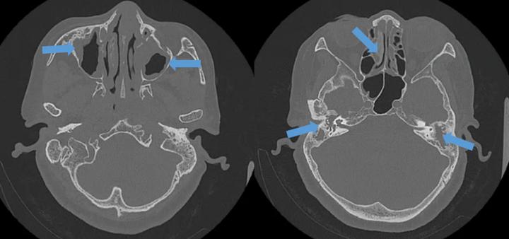 中耳炎引起耳朵越来越聋,小小的中耳炎为什么治不好