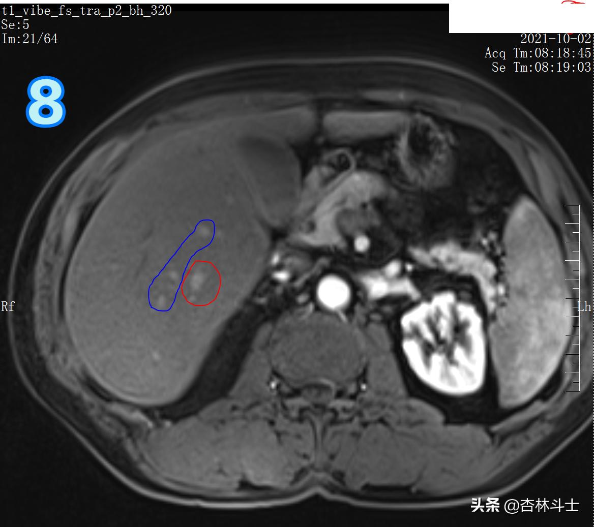 肝癌8公分肿瘤能活多久,肝癌细胞最大长多大