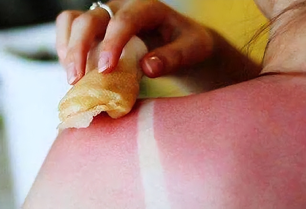 黛昂丝皮肤晒伤后的急救与护理，让你的肌肤快速恢复如初