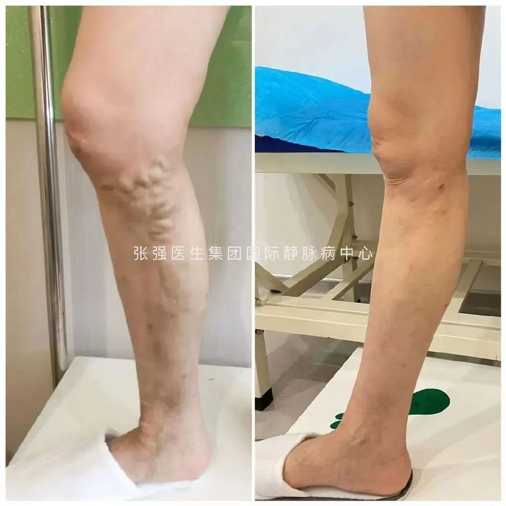 静脉曲张可以根治吗,静脉曲张能治好吗