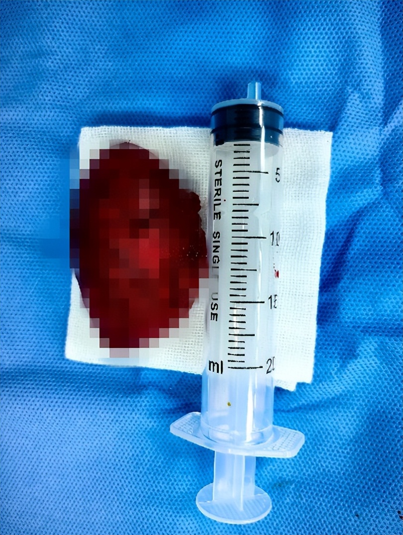 肛肠病医院二病区成功实施骶尾部巨大肿物切除术