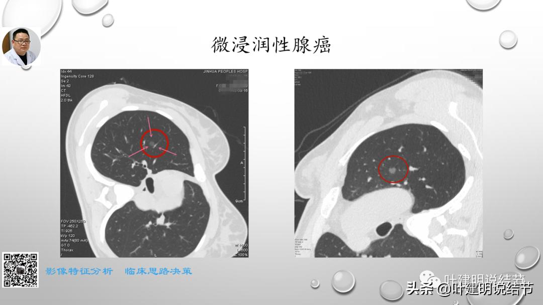 在《一脉阳光》呼吸影像诊断专题培训班上的讲课PPT（第一部分）