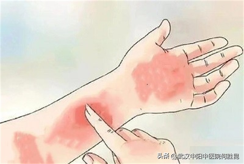 胳膊和脖子痒挠一下就起红疹子,胳膊挠出很多小红点