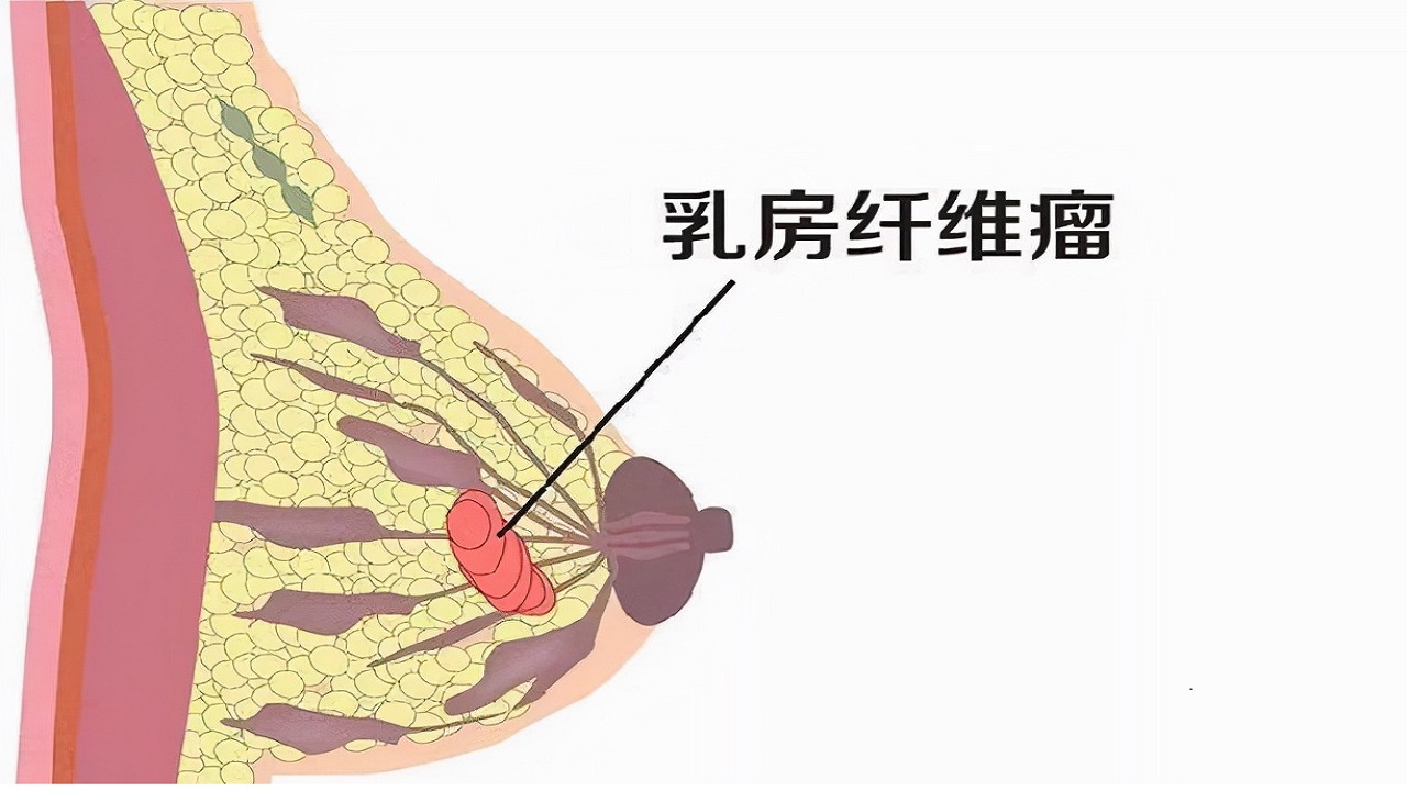 检查乳腺结节4类什么意思,乳腺结节手术是微创好还是开刀好