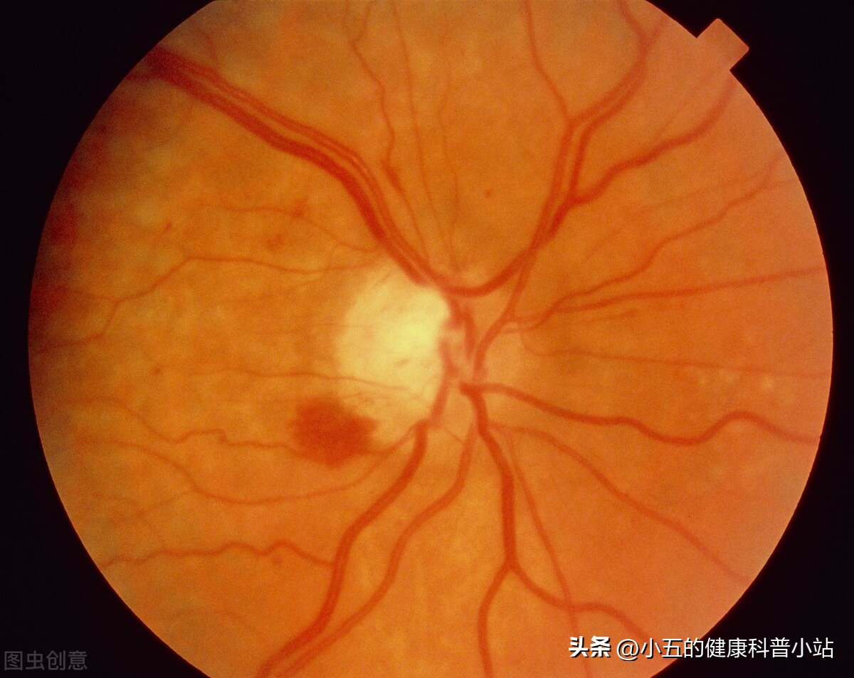 酚麻美敏片治疗细菌性感冒,酚麻美敏片是治疗感冒还是退烧