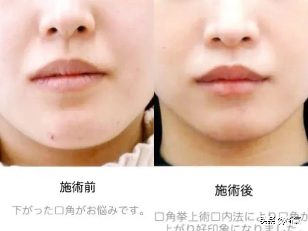 嘴唇薄变丰满,嘴唇变凸变丑怎么办