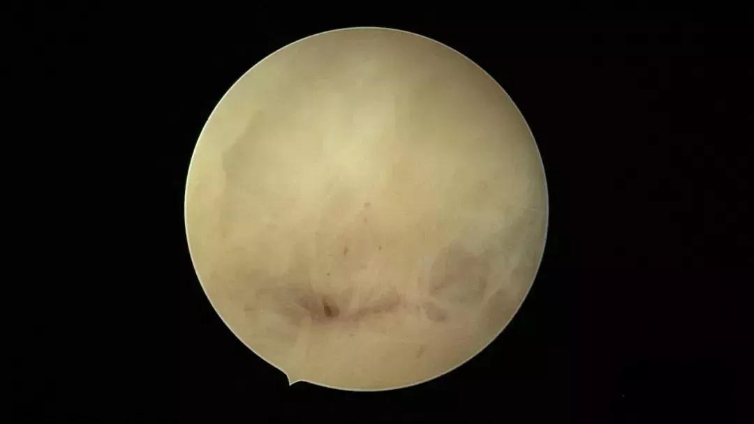 子宫里也会有脓？！这不是危言耸听，图文带你看懂