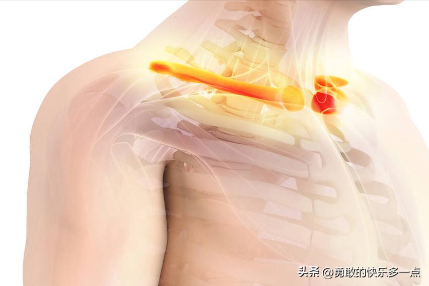 锁骨骨折错位不治疗会怎样,锁骨骨折处理