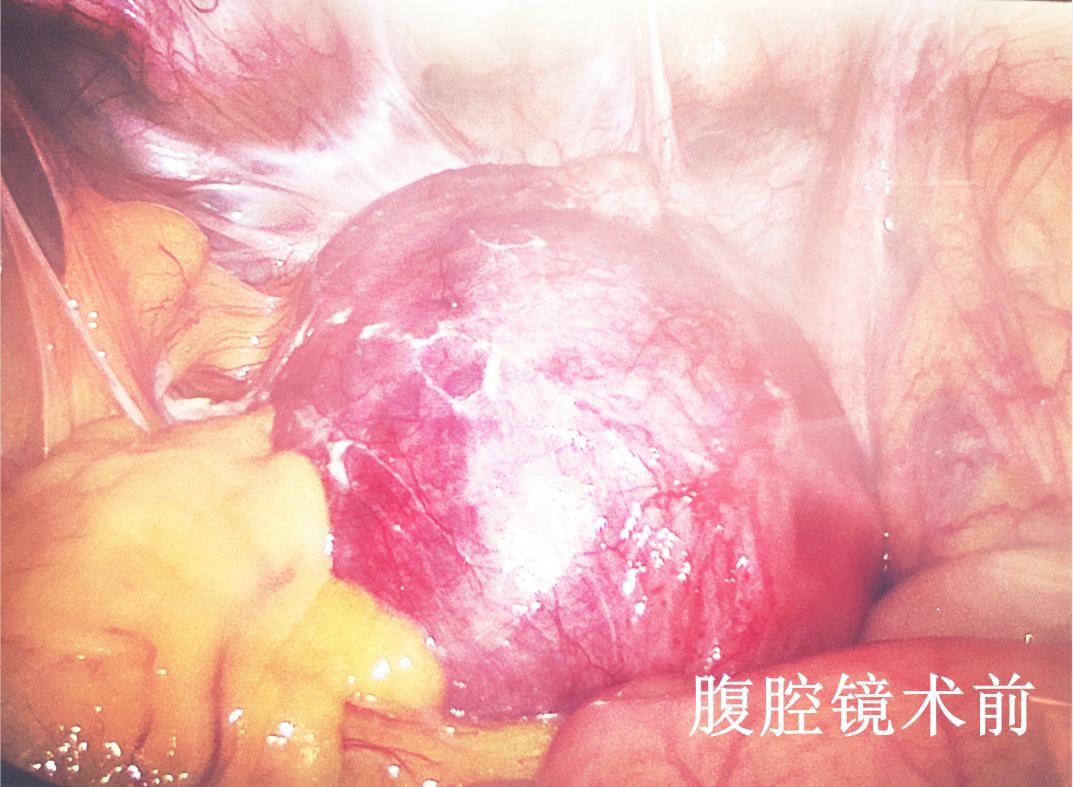 宫外孕大出血手术成功,腹腔镜下肝部分切除术大出血