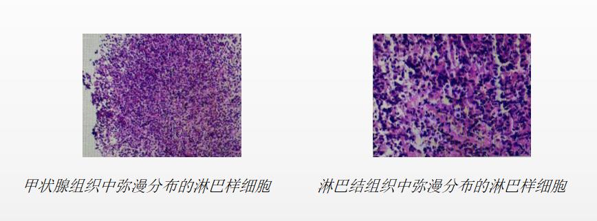 64岁女患者脖子肿痛，病因为何？多学科诊疗让患者获益最大化