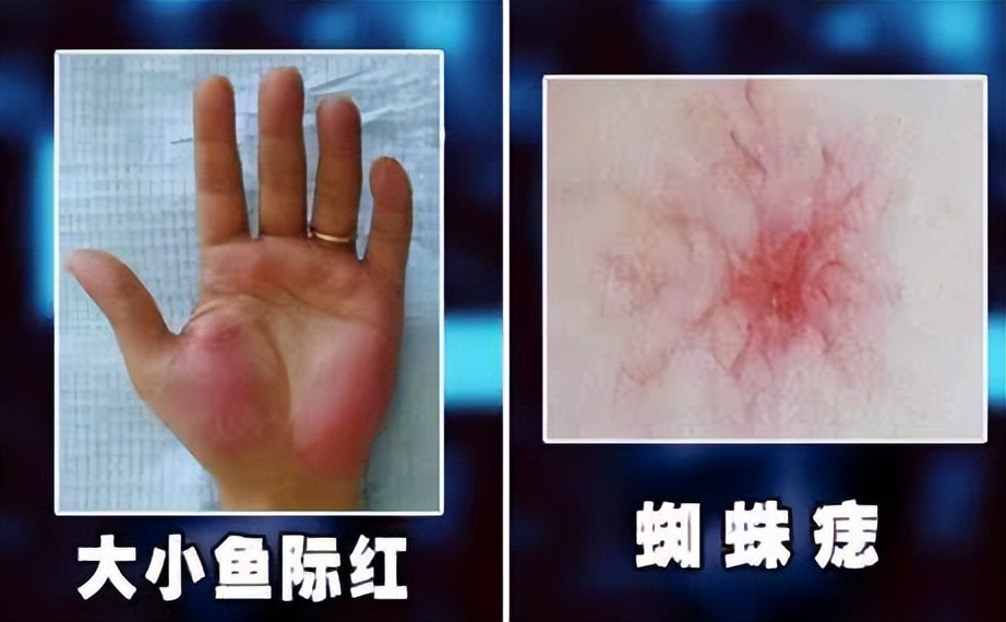 乙肝应该看中医还是西医,乙肝小三阳看中医好还是西医好