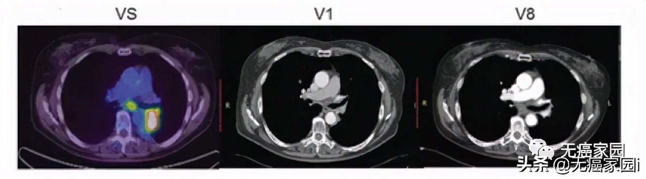 新型car-t疗法,CAR-NK疗法