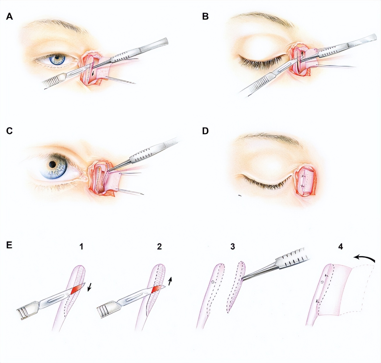 泪囊吻合手术和置管有啥区别,泪囊切除术是几类切口