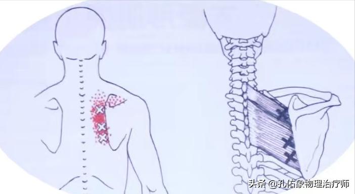 肩膀颈椎病症状,肩膀疼引起的颈椎病怎么治