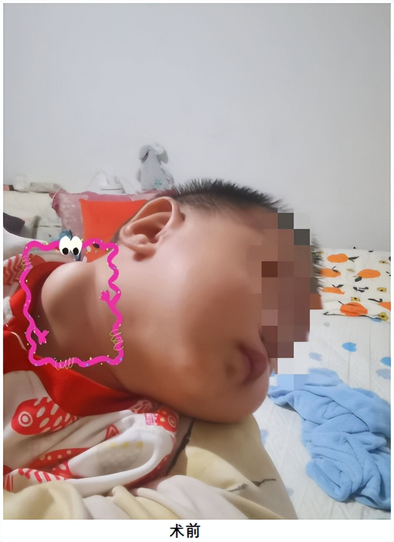 淋巴管瘤微创介入要打麻药吗,淋巴管瘤的微创治疗