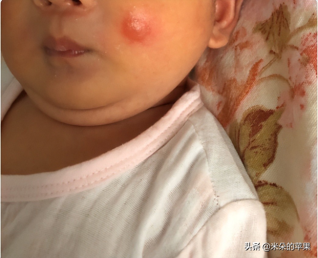 孩子被蚊子咬了很痒怎么办,孩子被蚊子咬痒得厉害怎么办