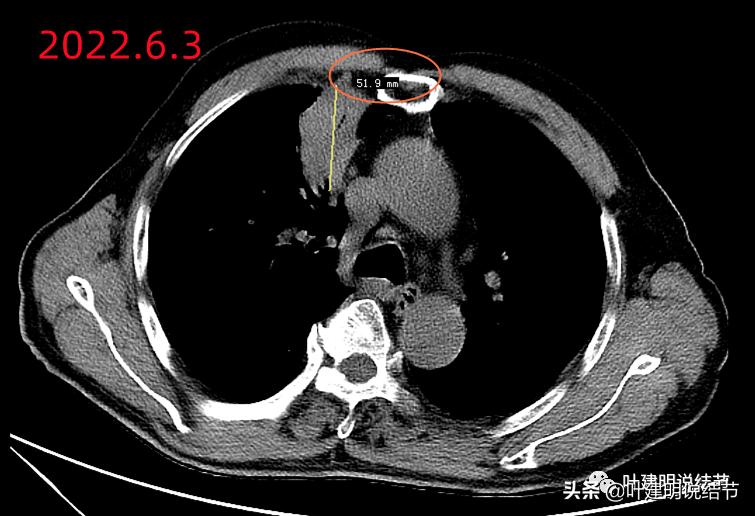 经验：肺占位超6厘米，不是癌还会是什么？临床上仍得多个心眼